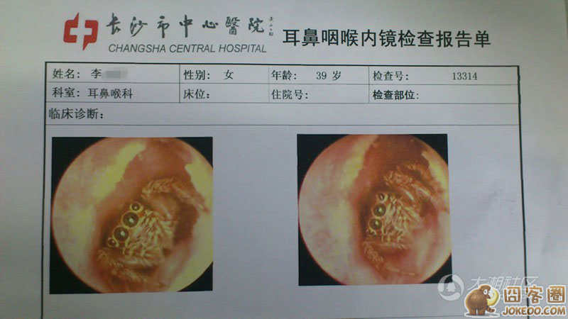 惊!一女子耳道暗藏一只活蜘蛛 医院检查吓得抓狂-囧客圈